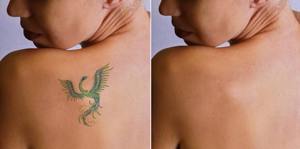 SINTATTOO centro eliminación de tatuajes Los Remedios Sevilla